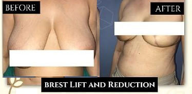 Breast Reduction Before & After Photo - Dr-Karishma-Kagodu