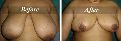 Breast Reduction Before & After Photo - Dr-Akshay-Rout
