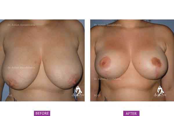Breast Reduction Before & After Photo - Dr-Ashish-Davalbhakta