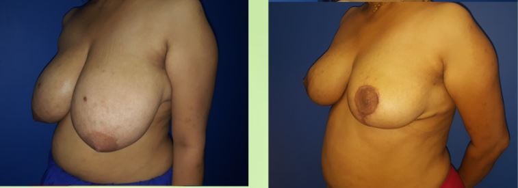 Breast Reduction Before & After Photo - Dr-Ashutosh-Shah