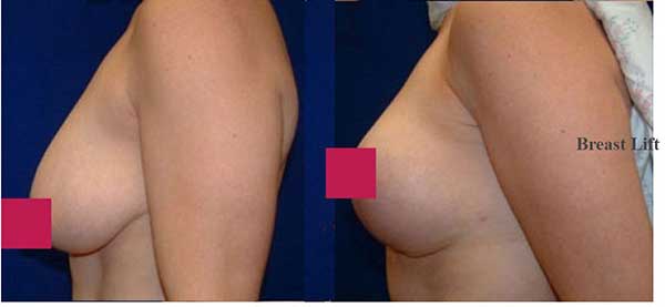 Breast Reduction Before & After Photo - Dr-E-kovarthini