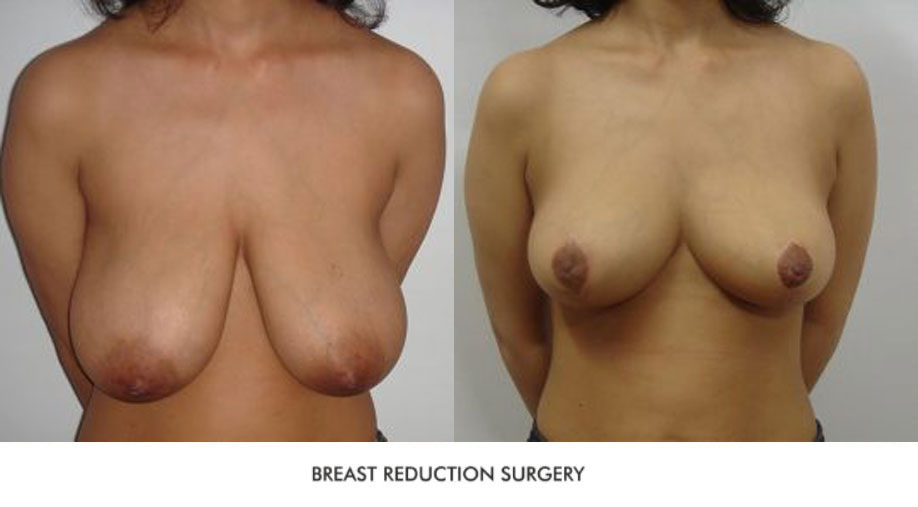 Breast Reduction Before & After Photo - Dr-Priti-Shukla