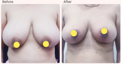 Breast Reduction Before & After Photo - Dr-Rajat-Gupta