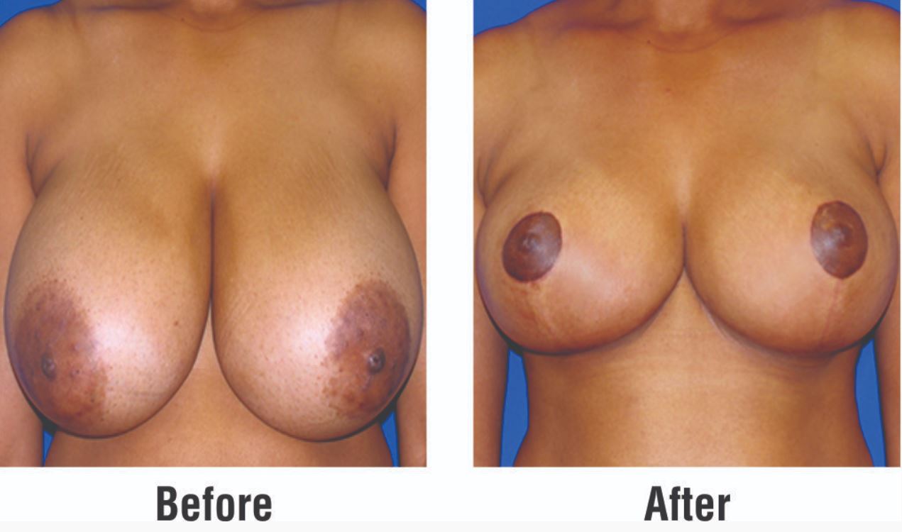 Breast Reduction Before & After Photo - Dr-Ravi-Rahajan