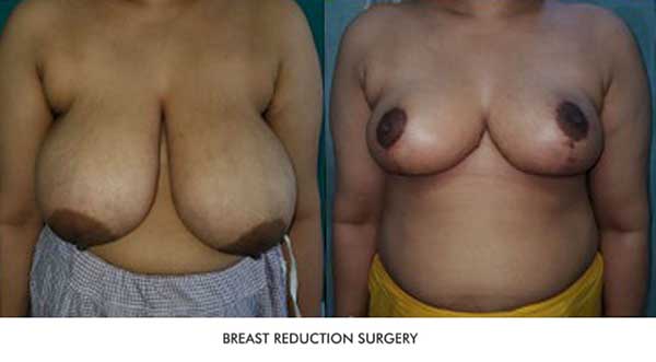 Breast Reduction Before & After Photo - Dr-Sumit-Malhotra
