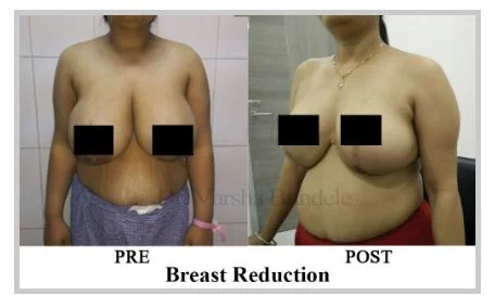 Breast Reduction Before & After Photo - Dr-Varsha-Bundele