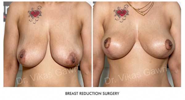 Breast Reduction Before & After Photo - Dr-Vikas-Gawri