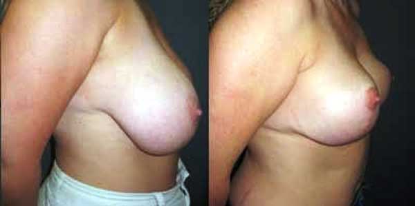 Breast Reduction Before & After Photo - Dr-Kulwant-Bhangoo